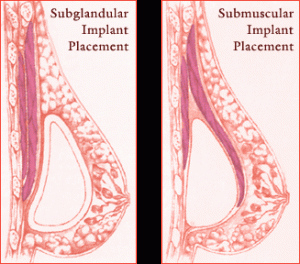 breast_implant_diagram1