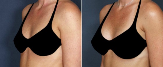 dr-saltz-breast-augmentation-46b-bikini