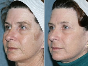 fraxel-repair-07-full-face-b-small