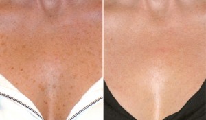 fraxel_chest_01