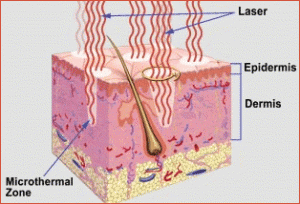 fraxel_laser_diagram