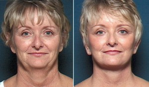 san-diego-facelift-1