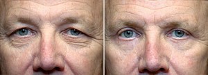 san-diego-facelift-eyelid-surgery-1