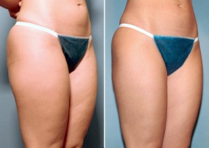 san-diego-liposuction-6a