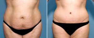 san-diego-tummy-tuck-e2