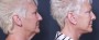 Dr. Brahme Facelift Patient 11