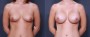 Dr. Brahme Breast Augmentation Patient 33