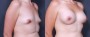 Dr. Roark Breast Augmentation Patient 16