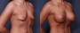 Dr. Brahme Breast Augmentation Patient 34