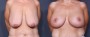 Dr. Grzeskiewicz Breast Lift Patient 10