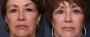 Dr. Grzeskiewicz Eyelid Lift Patient 4