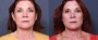Dr. Roark Facelift Patient 8