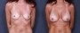 Dr. Grzeskiewicz Breast Augmentation Patient 27