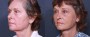 Dr. Roark Facelift Patient 9