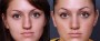 Dr. Brahme Rhinoplasty Patient 11