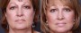 Dr. Brahme Facelift Patient 12