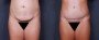 Dr. Saltz Tummy Tuck Patient 14