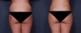 Dr. Grzeskiewicz Liposuction Patient 6