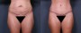 Dr. Grzeskiewicz Tummy Tuck Patient 12