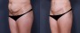 Dr. Brahme Tummy Tuck Patient 10