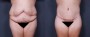 Dr. Grzeskiewicz Tummy Tuck Patient 11