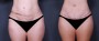 Dr. Saltz Tummy Tuck Patient 13