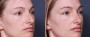 Dr. Brahme Rhinoplasty Patient 12