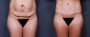 Dr. Saltz Tummy Tuck Patient 15