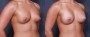 Dr. Brahme Breast Augmentation Patient 41