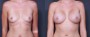 Dr. Saltz Breast Augmentation Patient 59