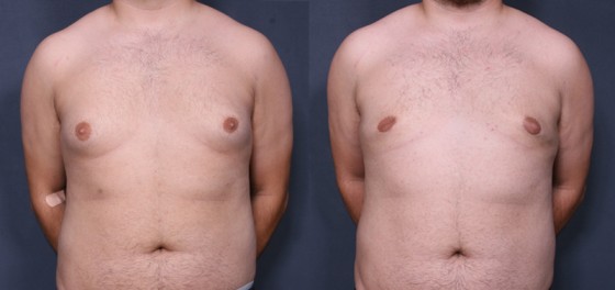 Dr. Grzeskiewicz Male Breast Reduction Patient 1