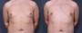 Dr. Grzeskiewicz Male Breast Reduction Patient 1