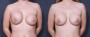 Dr. Brahme Breast Augmentation Revision Patient 2