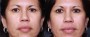 Dr. Brahme Eyelid Lift Patient 8