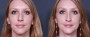 Dr. Brahme Rhinoplasty Patient 13