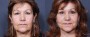 Dr. Brahme Facelift Patient 13
