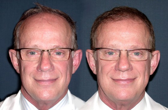 218HairTransplant