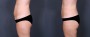 Dr. Brahme Liposuction Patient 1