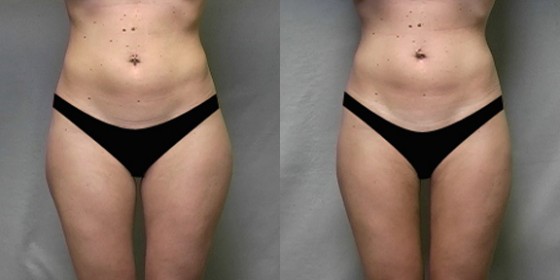 556007LHSLipo 556007LHSLipo