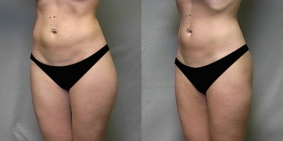 556007LHSLipo2 556007LHSLipo2