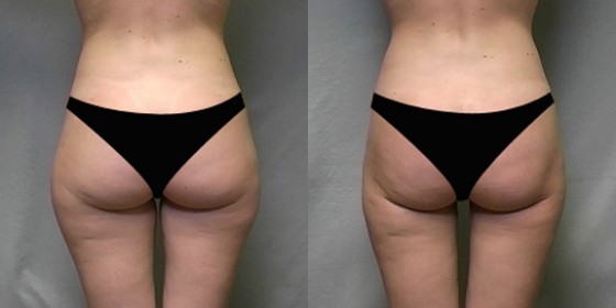 556007LHSLipo3 556007LHSLipo3