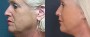 Dr. Brahme Facelift Patient 10