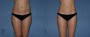 Dr. Grzeskiewicz Liposuction Patient 4