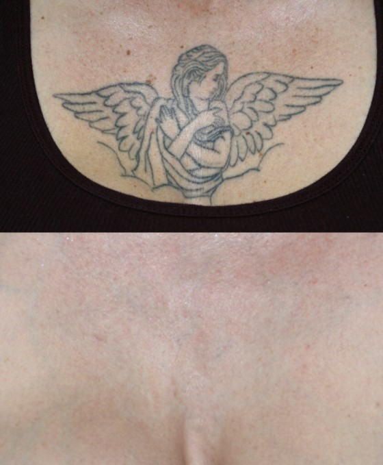 557362TattooRemoval