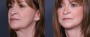 Dr. Brahme Facelift Patient 8