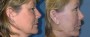 Dr. Grzeskiewicz Facelift Patient 4