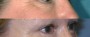 Dr. Grzeskiewicz Eyelid Lift Patient 2