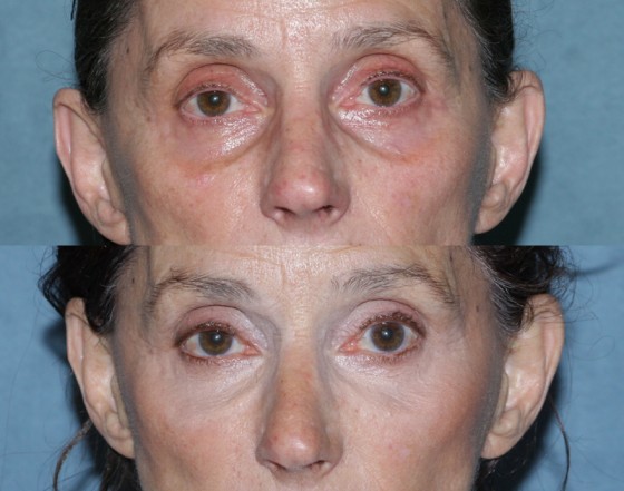 564042Restylane1