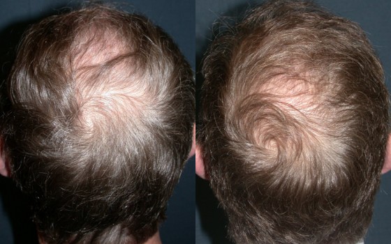 565218Hairtransplant-2