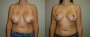 Dr. Grzeskiewicz Breast Lift Patient 6
